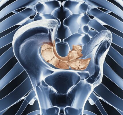 left hip fracture icd 10