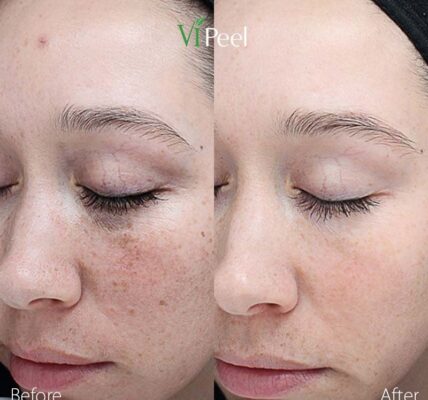 chemical peel after and before