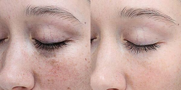 chemical peel after and before